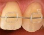 محافظت از دندان‌ها با استفاده از نانوذرات