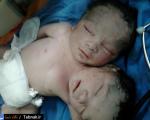 عکس: تولد نوزادی با دو سر در دزفول