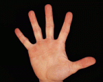 نتیجه تحقیقات جدید حاكیست:  مردانی با انگشت سبابه بلندتر، كمتر سرطان پروستات می‌گیرند