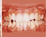 22 عادتی که دندان‌ها را خراب می‌کنند