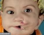 جراحی پسری که دو دهان دارد!! + عکس