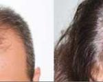 ریزش مو در زنان و مردان و تفاوت های آن