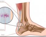 بهترین راه درمان پارگی تاندون ساق پا
