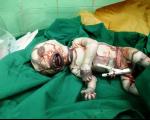 زنان باردار این تصاویر را نگاه نكنند/ تولد یک نوزاد با یک بیماری وحشتناک در ایران+تصاویر(+18)