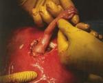 نوزاد درون رحم دست پزشک را گرفت ( تصویر )