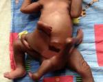 عکس: تولد نوزادی با 8 دست و پا!