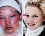 تمام بدن و صورت این دختر ۱۹ساله تاول زد!+عکس