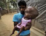 نوزاد هندی با جمجمه بادکنکی!