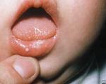 راههای درمان برفک دهان در کودکان