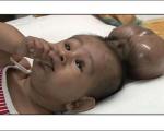 جراحان سر دوم کودک 8 ماهه هندی را جدا کردند (+عکس)