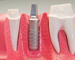 7 نکته ای که باید درباره ایمپلنت دندان بدانید
