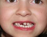 روشهای مراقبت از دندان شیری کودکان