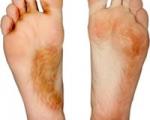 بیماری پای ورزشكاران‌ ( Athlete's foot )