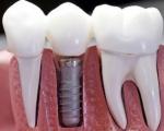 چه کسانی نمی توانند از ایمپلنت دندان استفاده کنند؟