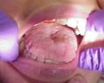 التهاب زبان (گلوسیت)