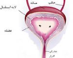 التهاب مثانه در خانمها (سندرم مثانه دردناک)