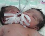 تولد نوزادی دو سر در دزفول! + عکس