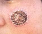 سالك یك عفونت انگلی پوست است كه توسط پشه خاكی منتقل می شود