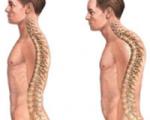 درمان قوز پشتی با چند حرکت ورزشی (+ تصاویر)