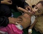 سوء تغذیه؛ قاتل اصلی کودکان در جهان