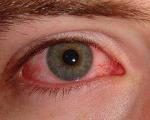 التهاب ملتحمه ( قرمزی چشم )