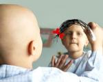 سرطان بعد از تروما دومین عامل مرگ كودكان زیر یك سال است