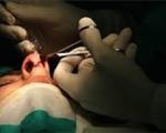 حداقل دستمزد مصوب جراحی بینی ۳ تا ۶ میلیون تومان!/ عوارض اعمال جراحی غیرمتعارف گوش