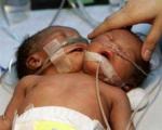 تولد نوزاد دو سر در برزیل + عکس