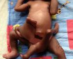 نوزادی با 8 دست و پا! +عکس