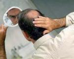 ژنتیک شایع ترین علت ریزش موی سر آقایان