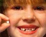 دندان های شیری پوسیده