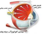 درمان‌های رایج بیماری‌های چشمی