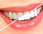 سفیدکننده های خانگی برای سفید کردن دندان‌ها در نوروز