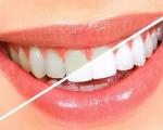 رازهایی برای داشتن دندان های مرواریدی