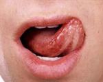کالبدشکافی سرطان «زبان»