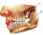 مراقب عوارض دندان عقل باشید