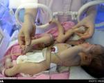 عکس: نوزادِ 8 دست‌ و پا