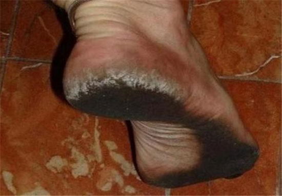 مردی که پاهایش تبدیل به کفش شد +عکس