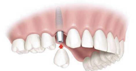 7 نکته ای که باید درباره ایمپلنت دندان بدانید