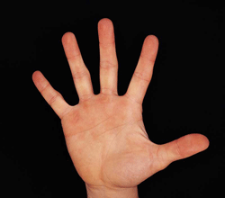 مردانی با انگشت سبابه بلندتر، كمتر سرطان پروستات می‌گیرند