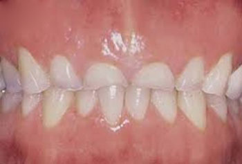 دندان‌قروچه ، علائم دندان قروچه