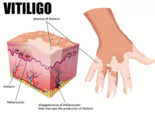 ویتیلیگو (vitiligo) علایم ، عوارض ، درمان و…