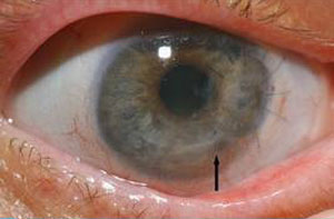 بیماری کراتیت, التهاب قرنیه چشم