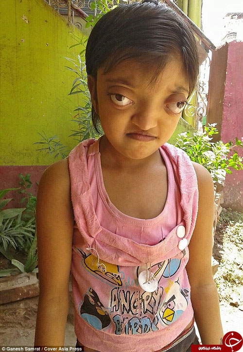 تصاویر/ بیماری نادر یک دختر بچه