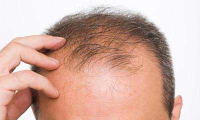 درمان  ریزش موی مردان