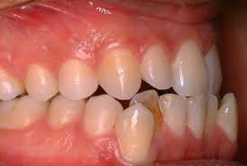 ارتودنسی های نامرئی, درمان های ارتودنسی, پوسیدگی دندان
