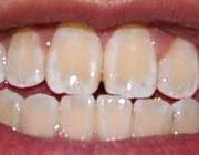 علت زرد شدن دندان ها,علت  بدرنگ شدن دندان ها,راههای سفید کردن دندانها
