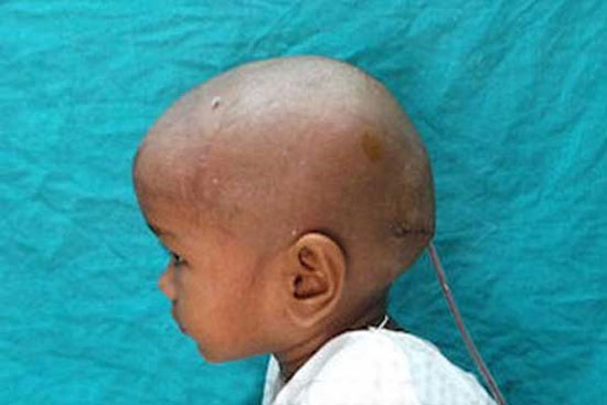 عکس/ تومور ۳ کیلویی در سر یک دختر!