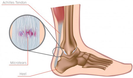 پارگی تاندون ساق پا قابل درمان است