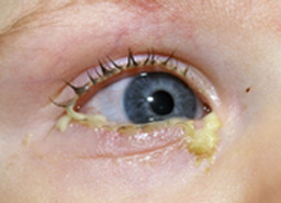 عفونت‌های ویروسی, ترشح چشم, آبریزش بینی